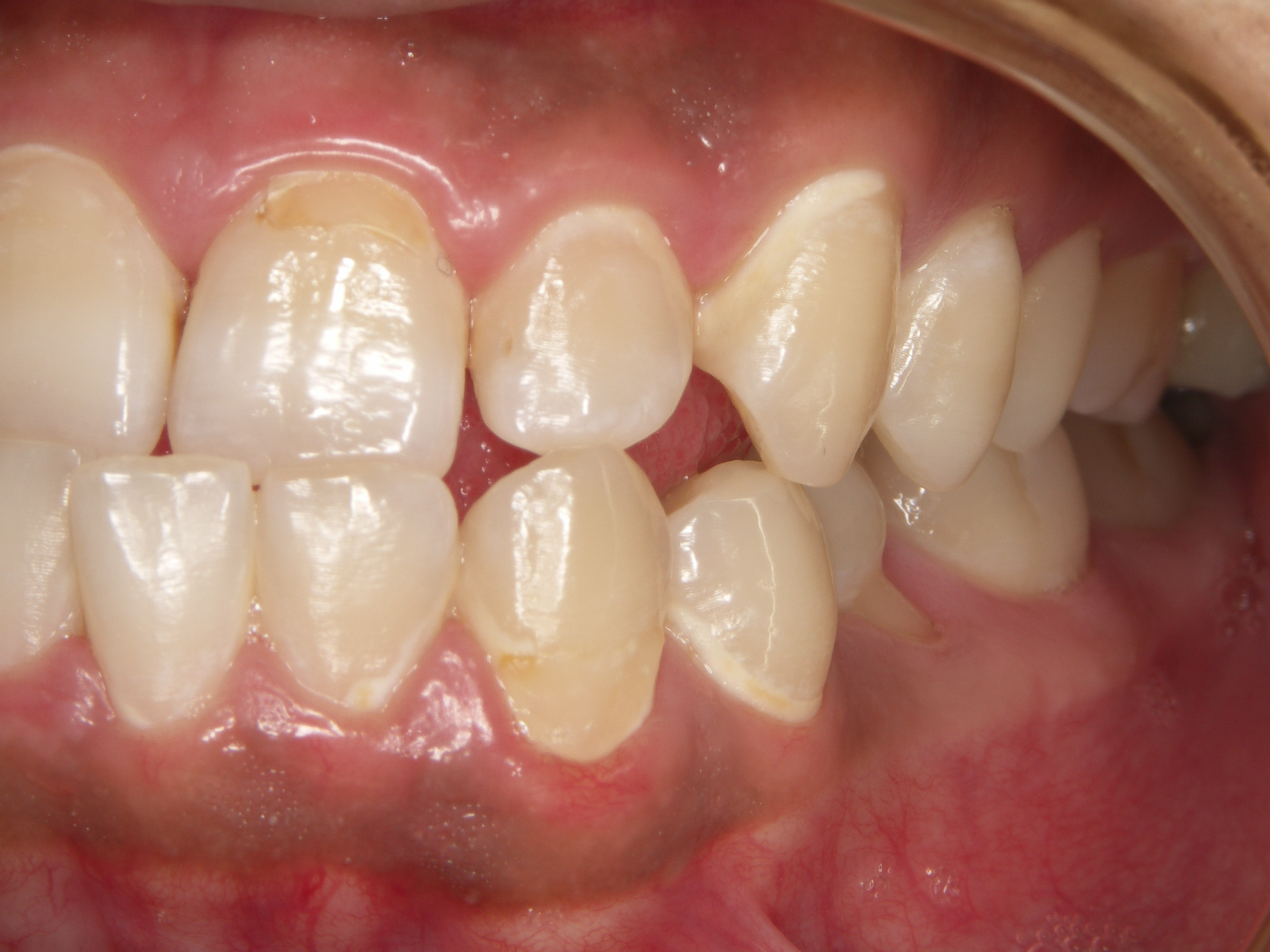 エナメル質の初期齲蝕 ブログ 古河市の歯医者 高尾歯科医院